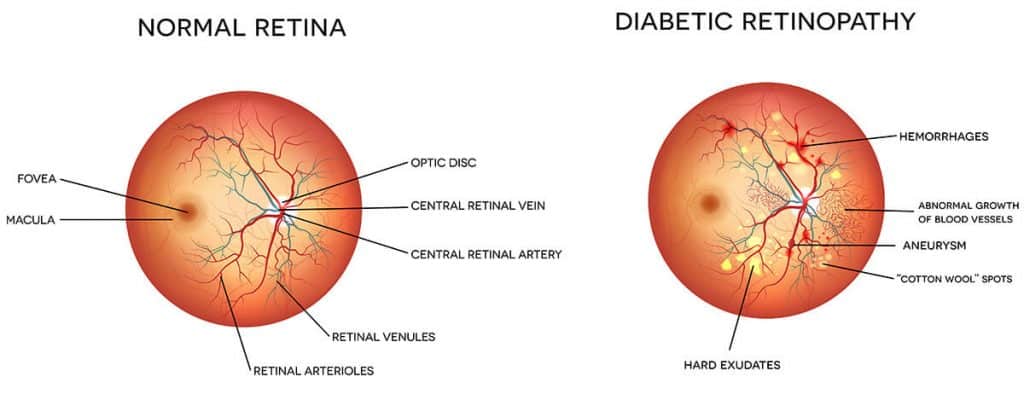 Chart Illustrating a Healthy Eye vs One With Diabetic Retinopathy