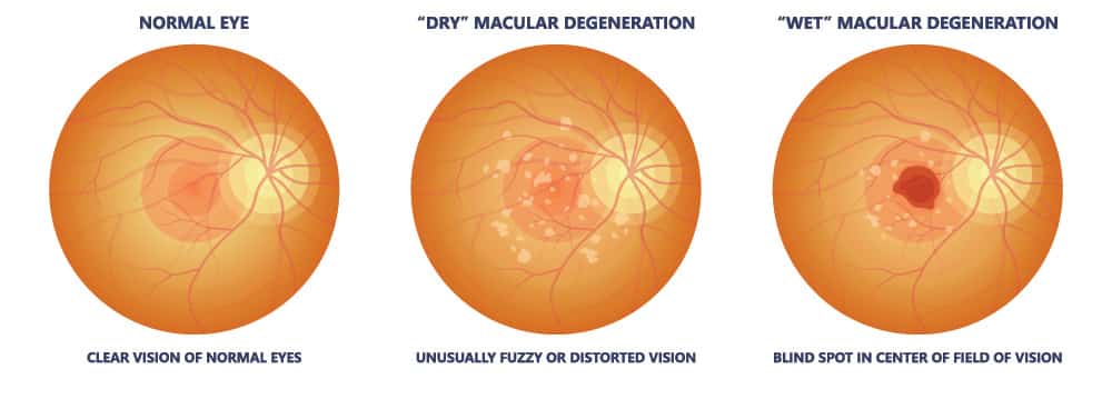 Chart Illustrating a Healthy Eye vs one with a degenerated macula