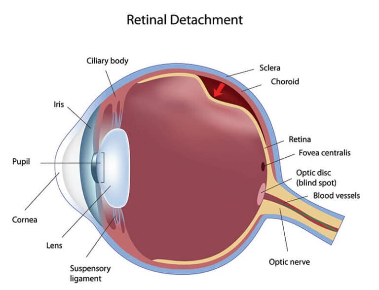 Retinal Tear / Retinal Detachment